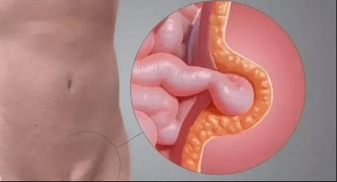 Conheça a hérnia inguinal, a mais comum no abdômen – SulMedical